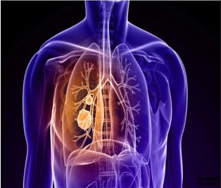 罗氏Tecentriq免疫组合疗法一线治疗肺癌，有望今年获批